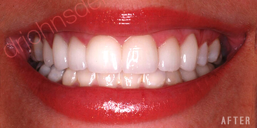 Dr-Johns-Dentistry-Services-IPS Express-Veneers